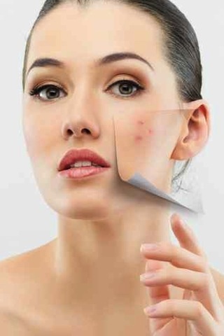 acne-22