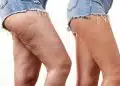 Cellulite dopo la gravidanza