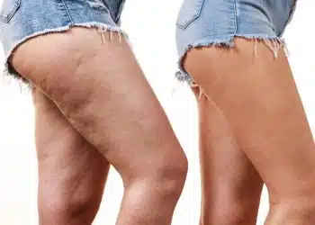 Cellulite dopo la gravidanza