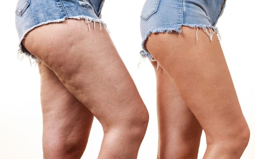 Cellulite dopo la gravidanza Cellulite dopo la gravidanza